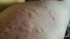 宝宝诱发荨麻疹原因